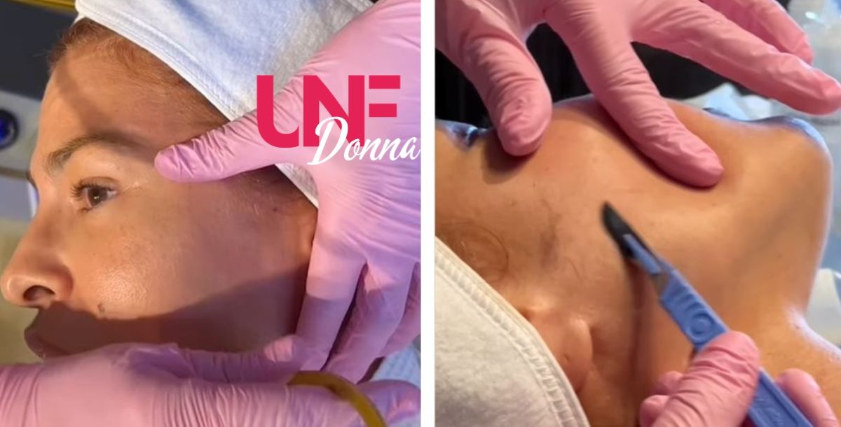 che cosa è il dermaplaning